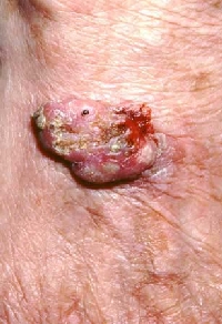 Cancerous Warts Pictures